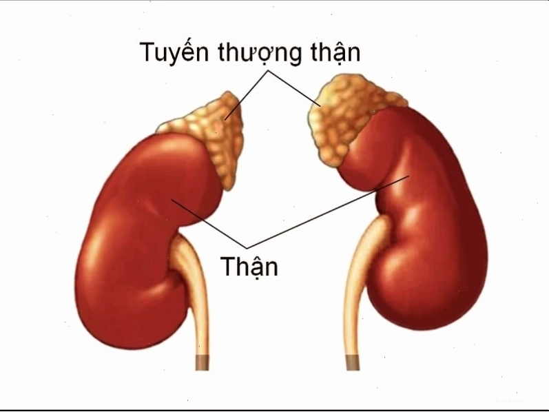 Addison là bệnh lý xảy ra khi tuyến thượng thận bị tổn thương