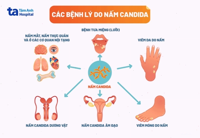 Ảnh infographic tổng hợp các bệnh lý do nấm candida gây ra trên cơ thể người