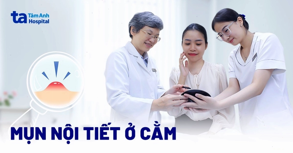 Ảnh minh họa các nốt mụn nội tiết tập trung ở vùng quanh cằm