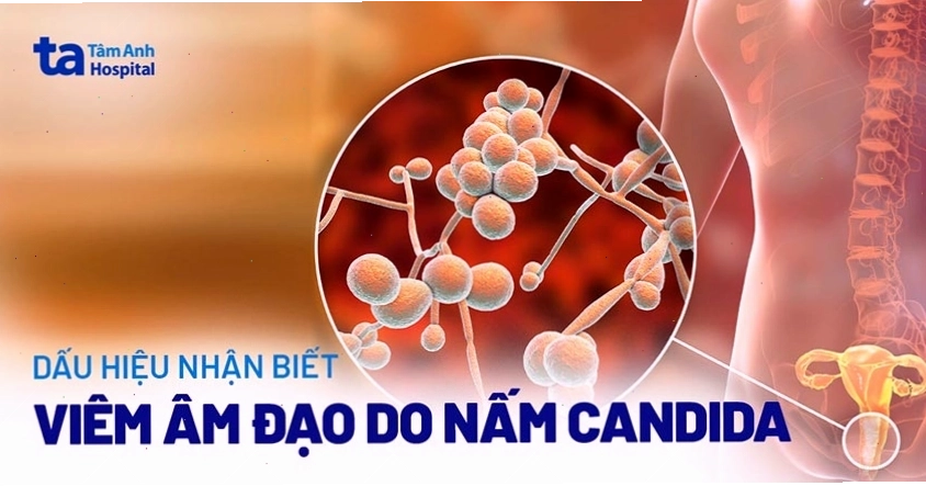Ảnh minh họa chăm sóc sức khỏe phụ khoa giúp phòng ngừa viêm nấm
