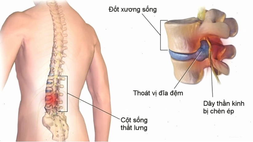 Ảnh minh họa cột sống