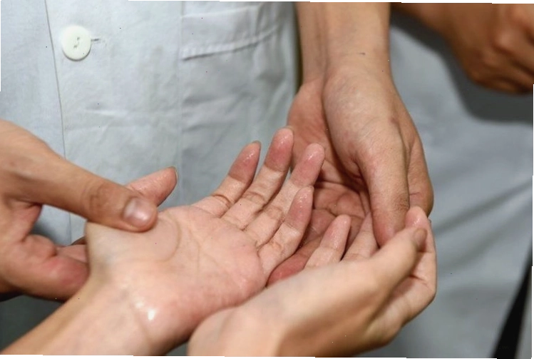 Ảnh minh họa tình trạng đổ mồ hôi tay chân do rối loạn thần kinh thực vật