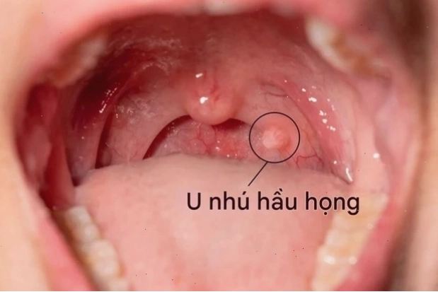 Ảnh mô phỏng dấu hiệu nhiễm HPV trên da