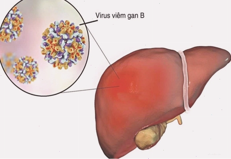 Ảnh mô phỏng gan bị tổn thương gây vàng da