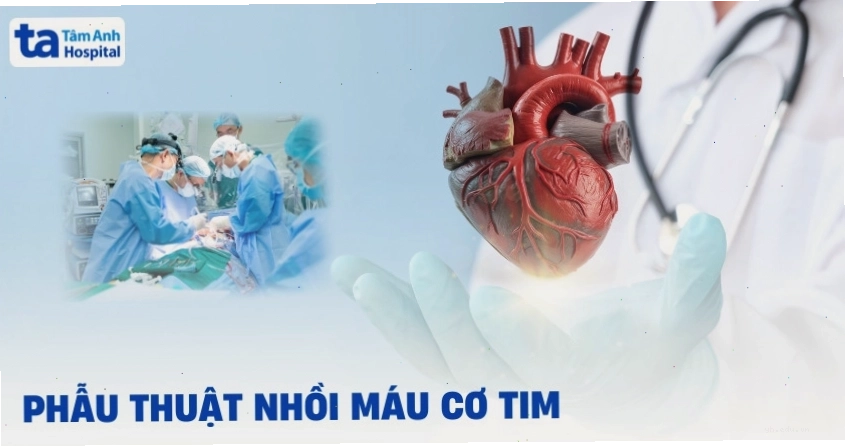 Ảnh mô phỏng phẫu thuật điều trị nhồi máu cơ tim cấp cứu