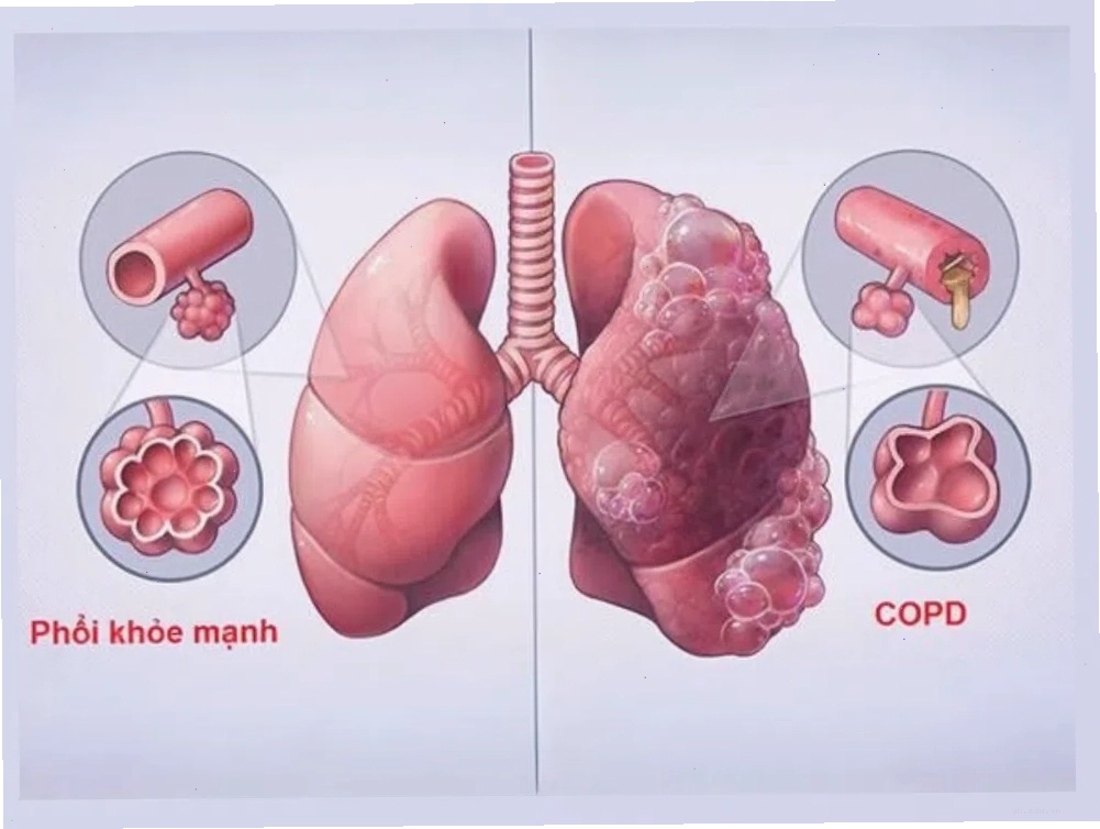 Ảnh mô phỏng so sánh cấu trúc giữa phổi bình thường và phổi bị tổn thương do khí phế thũng