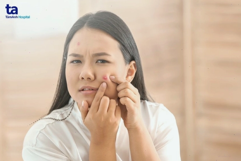 Ảnh mô phỏng tình trạng nổi mụn trứng cá do chế độ ăn nhiều đường