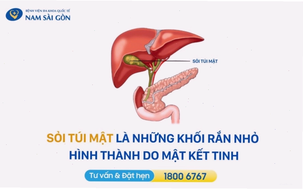 Ảnh mô tả các loại sỏi được hình thành bên trong túi mật của người bệnh