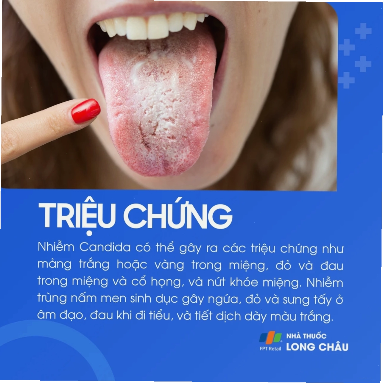 Ảnh mô tả các triệu chứng lâm sàng như mảng trắng và ngứa rát