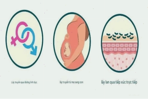 Ảnh mô tả nguyên nhân nhiễm HPV qua tiếp xúc trực tiếp