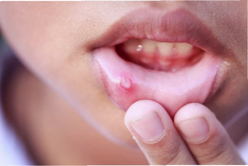 Ảnh nhiệt miệng 2