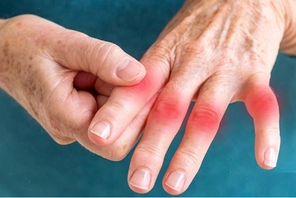 Ảnh triệu chứng phong thấp biểu hiện đau nhức và sưng tại các khớp ngón tay