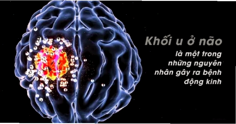 Ảnh u não