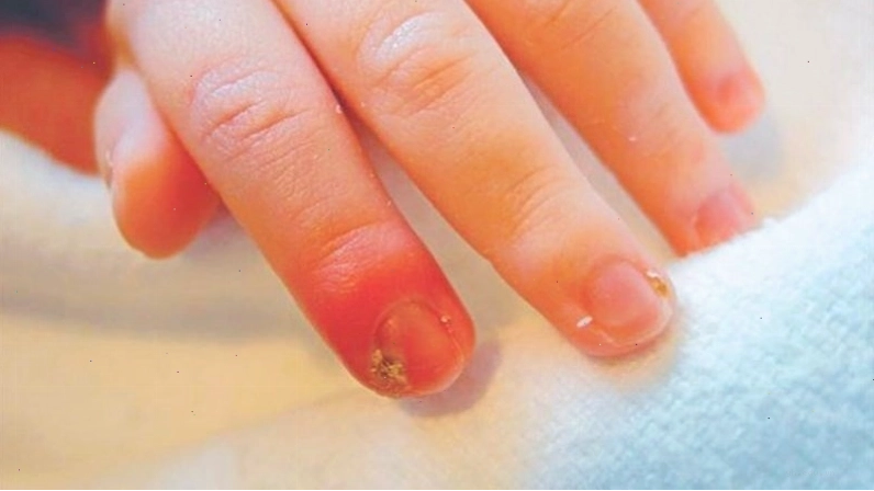 Áp xe đầu ngón tay là hiện tượng nhiễm trùng xảy ra ở vùng đốt xa của ngón tay