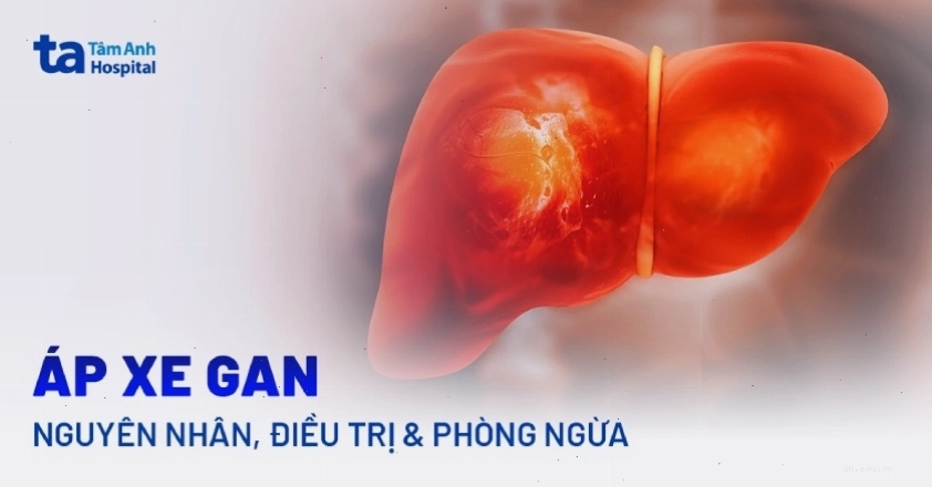 Áp xe gan