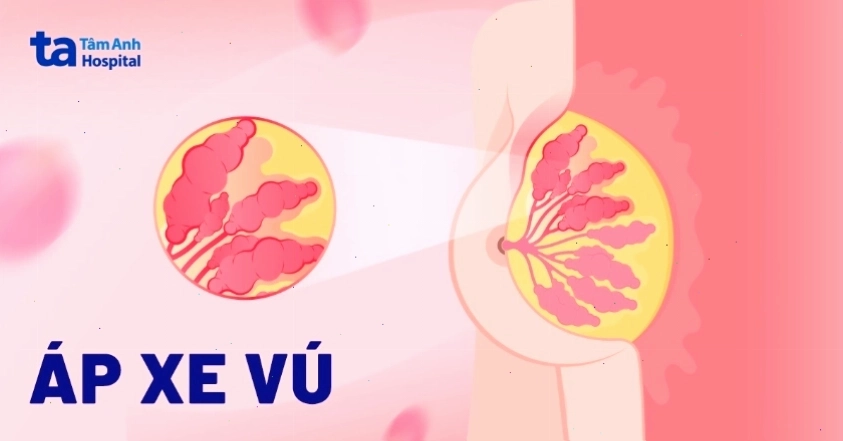 Áp xe vú