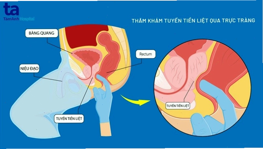 Bác sĩ thực hiện thăm khám tuyến tiền liệt qua đường trực tràng
