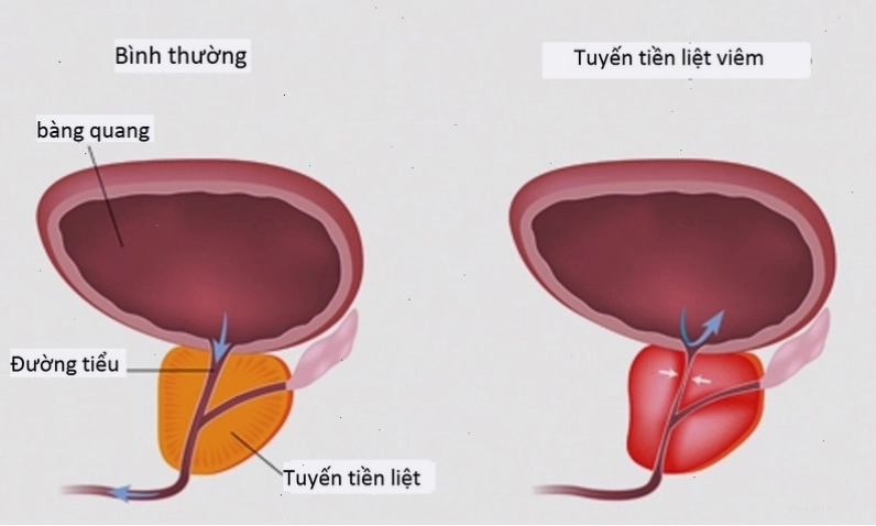 Bác sĩ tư vấn giải đáp thắc mắc về bệnh xuất tinh ra máu