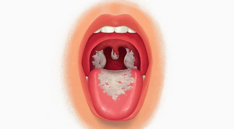 Bạch hàu là bệnh gì và những điều cần biết để bảo vệ sức khỏe