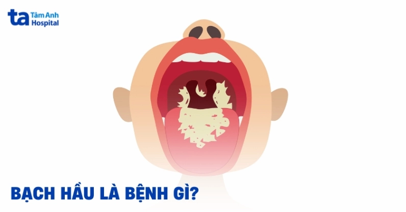 Bạch hầu là bệnh gì và những thông tin y khoa cần nắm vững