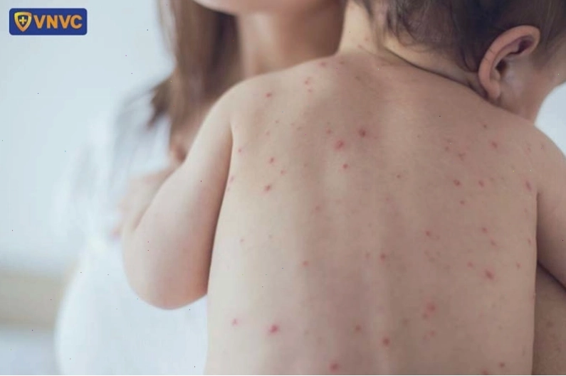 bé bị bệnh sởi