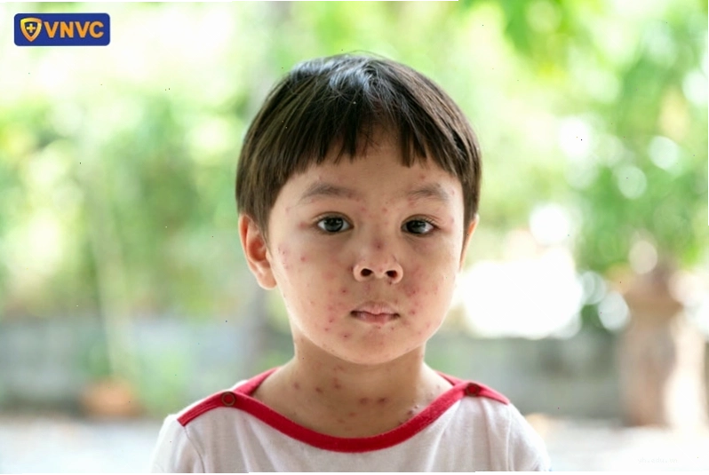 Bé trai bị các nốt thủy đậu trên vùng mặt
