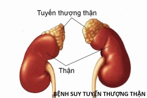 Bệnh addison là gì mô tả cơ chế