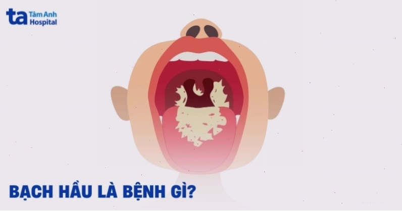 Bệnh bạch hầu là bệnh gì cần được nhận biết sớm