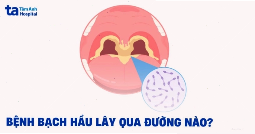 Bệnh bạch hầu lây qua đường nào