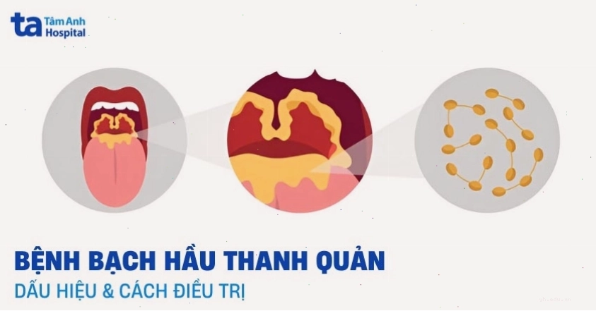 Bệnh bạch hầu thanh quản