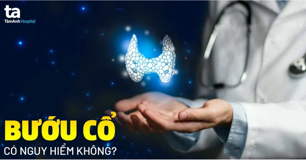 Bệnh bướu cổ có nguy hiểm không Khi nào cần điều trị