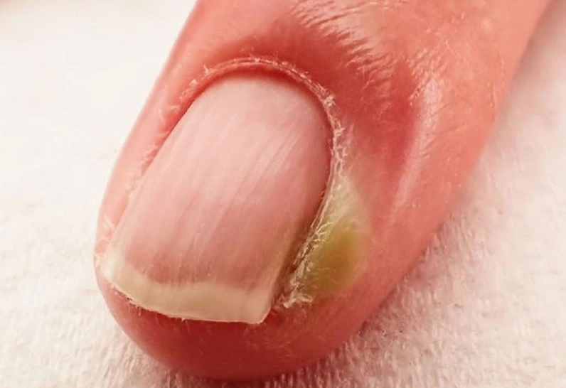 Bệnh chín mé là gì và các phương pháp xử lý y khoa an toàn