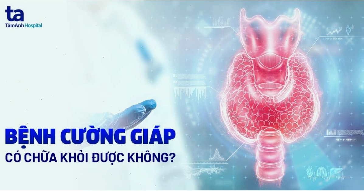 Bệnh cường giáp có chữa khỏi được không