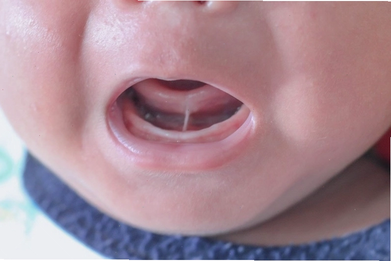 Bệnh dính thắng lưỡi xảy ra khi dây thắng lưỡi bị ngắn, dày hoặc căng, khiến các cử động của lưỡi trở nên hạn chế