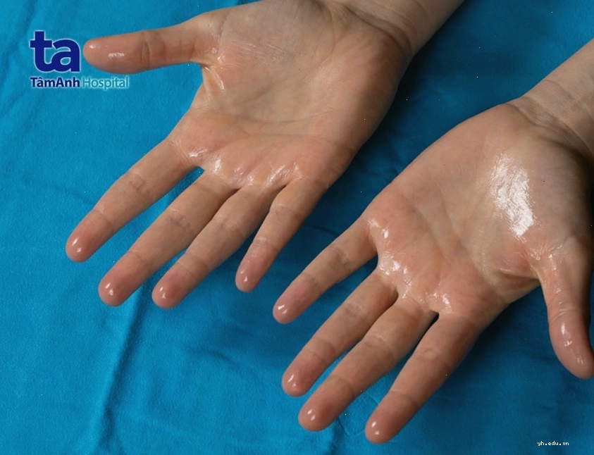 Bệnh do hệ thần kinh giao cảm gây ra tình trạng tiết mồ hôi