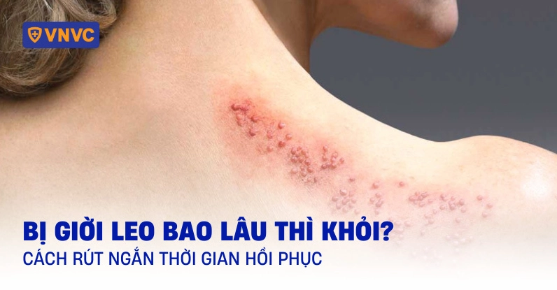 Bệnh dời leo là gì và những thông tin y khoa quan trọng bạn cần nắm rõ