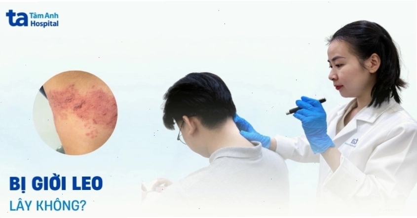 Bệnh giời leo có lây không và cách phòng ngừa