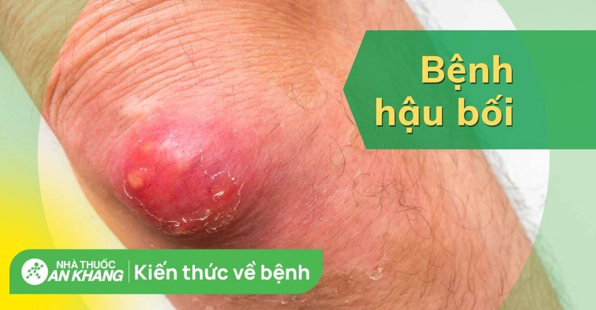 Bệnh hậu bối là gì và những thông tin y khoa quan trọng cần biết
