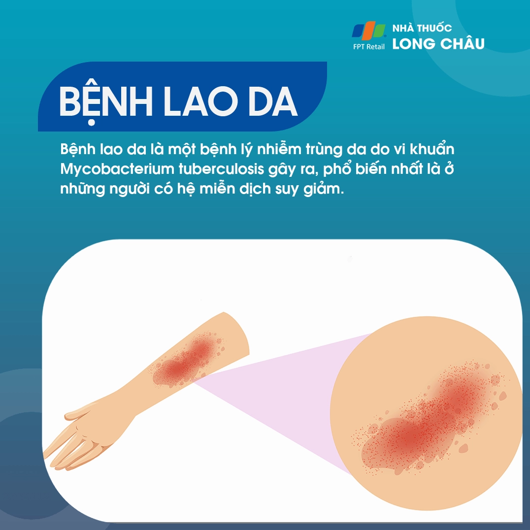 Bệnh lao da là gì và những kiến thức y khoa quan trọng cần biết