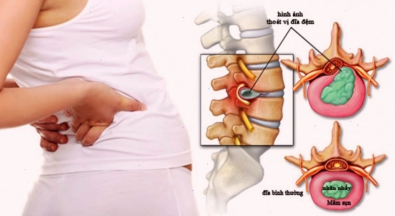 Bệnh lý thoát vị đĩa đệm cột sống cổ gây tê lan tỏa xuống bàn tay