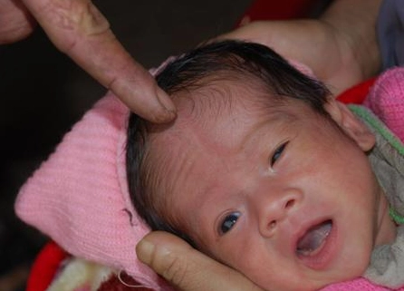 Bệnh mở khoá đầu là gì và sự thật đằng sau niềm tin dân gian