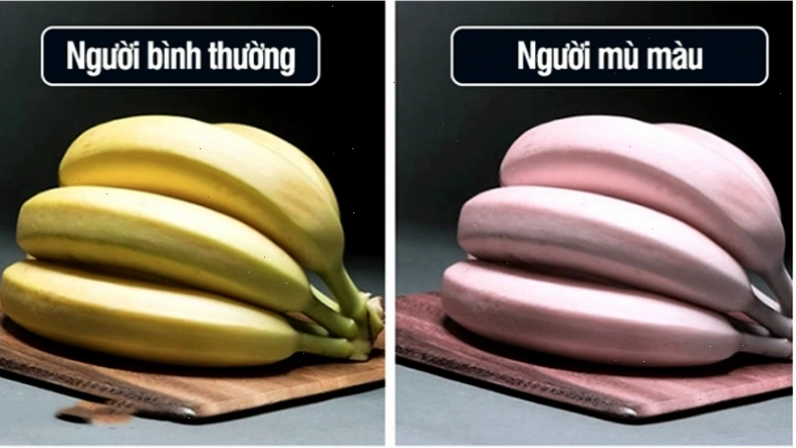 Bệnh mù màu là do đâu