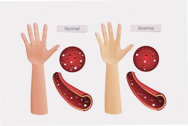 Bệnh nhân bị Anemia thường có dấu hiệu vàng da niêm mạc