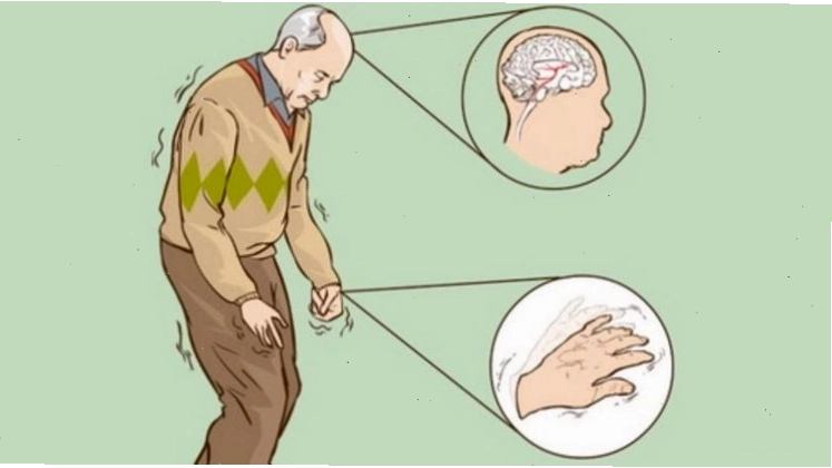 Bệnh Parkinson có thể là nguyên nhân gây ra tình trạng run