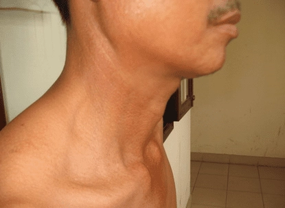 Bệnh pellagra là bệnh gì và những điều cần biết để bảo vệ cơ thể