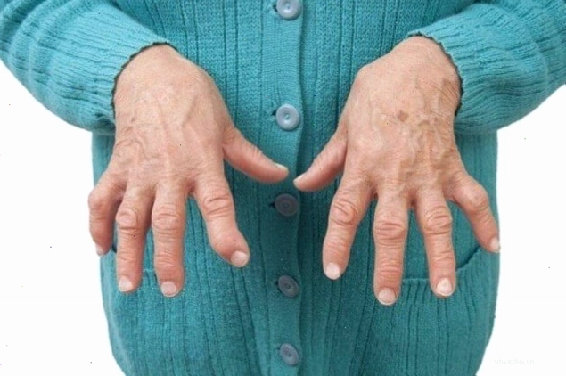 Bệnh phong thấp thường gặp ở người lớn