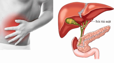 Bệnh sỏi túi mật là gì và những kiến thức cần biết để bảo vệ sức khỏe