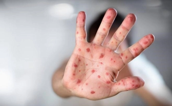 Bệnh tay chân miệng do virus gì và những điều cha mẹ cần ghi nhớ