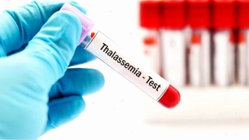 Bệnh Thalassemia nặng có thể khiến trẻ tử vong sớm do biến chứng thiếu máu nặng