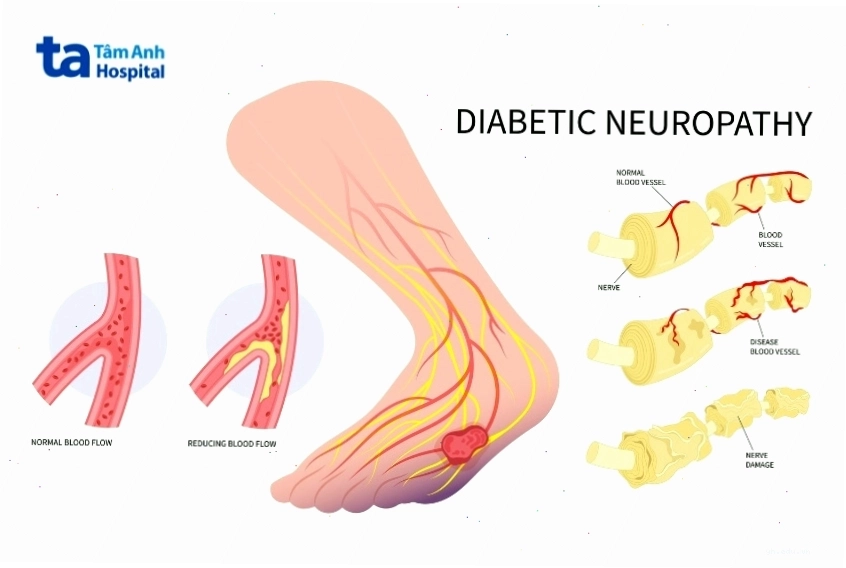 Bệnh thần kinh ngoại biên ảnh hưởng đến chân